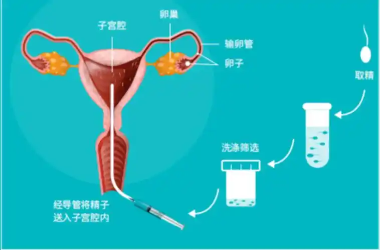 人工授精失败转试管婴儿要多少钱?国内普遍在3-10万