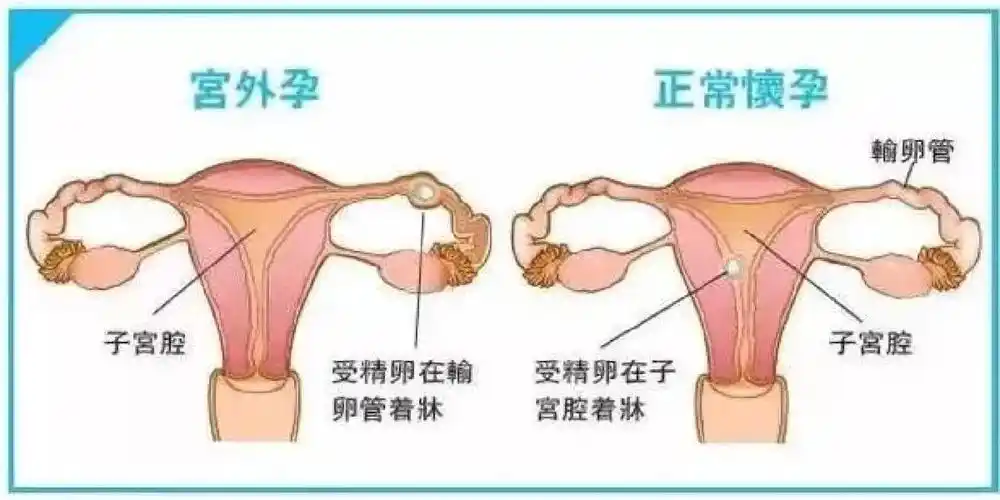 揭晓宫外孕早期的七个征兆表现，不规则阴道出血需要重点关注