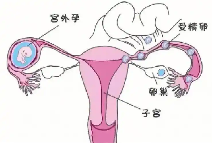 揭晓宫外孕早期的七个征兆表现，不规则阴道出血需要重点关注