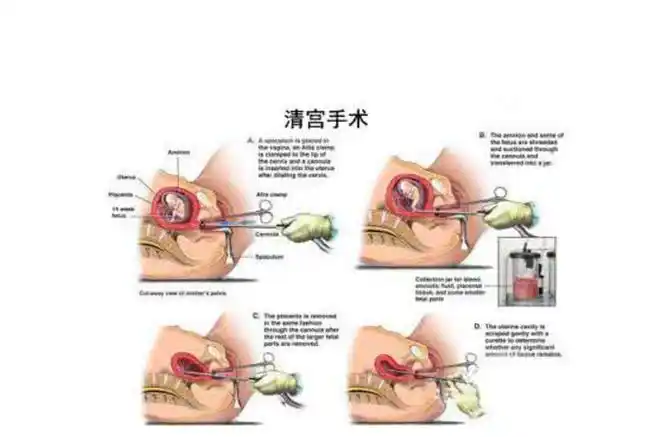 清宫一次内膜会变薄1mm-2mm左右吗？