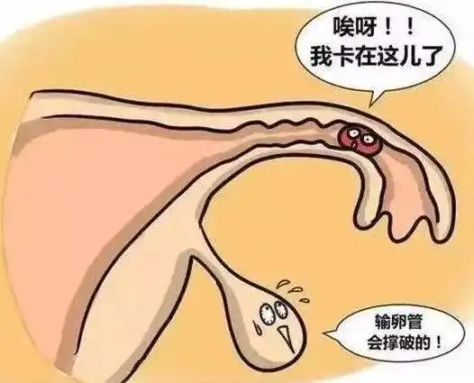 输卵管一侧堵塞一侧通畅做试管婴儿还是人工授精好？